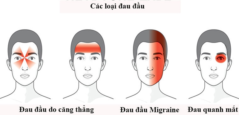 Đau đầu Migraine