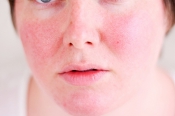 Mách bạn: 6 cách trị dị ứng da mặt nhanh nhất tại nhà